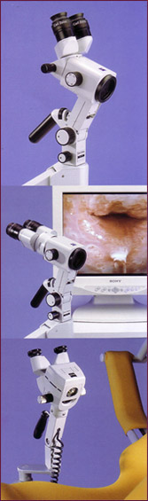 Colposcopia